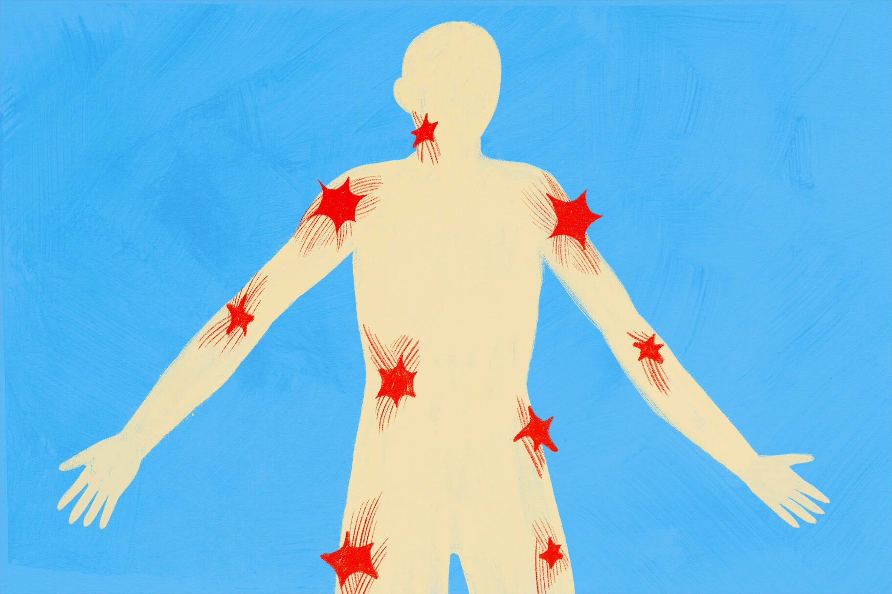 What Are Trigger Points—And How Can They Be Treated?