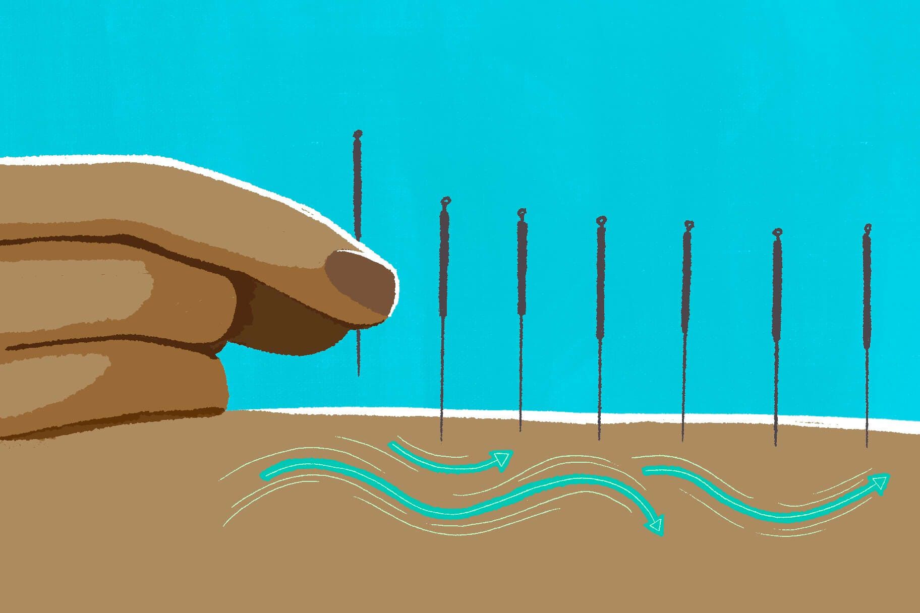 Dry Needling vs. Acupuncture: Everything You Need to Know