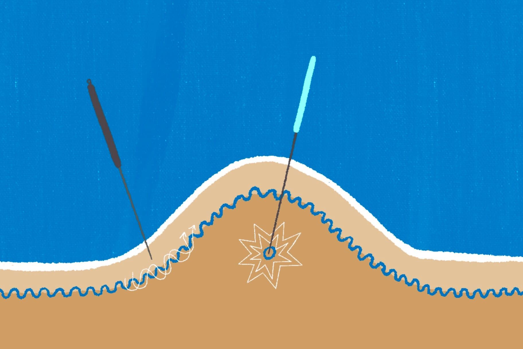 Dry Needling vs. Acupuncture: Everything You Need to Know