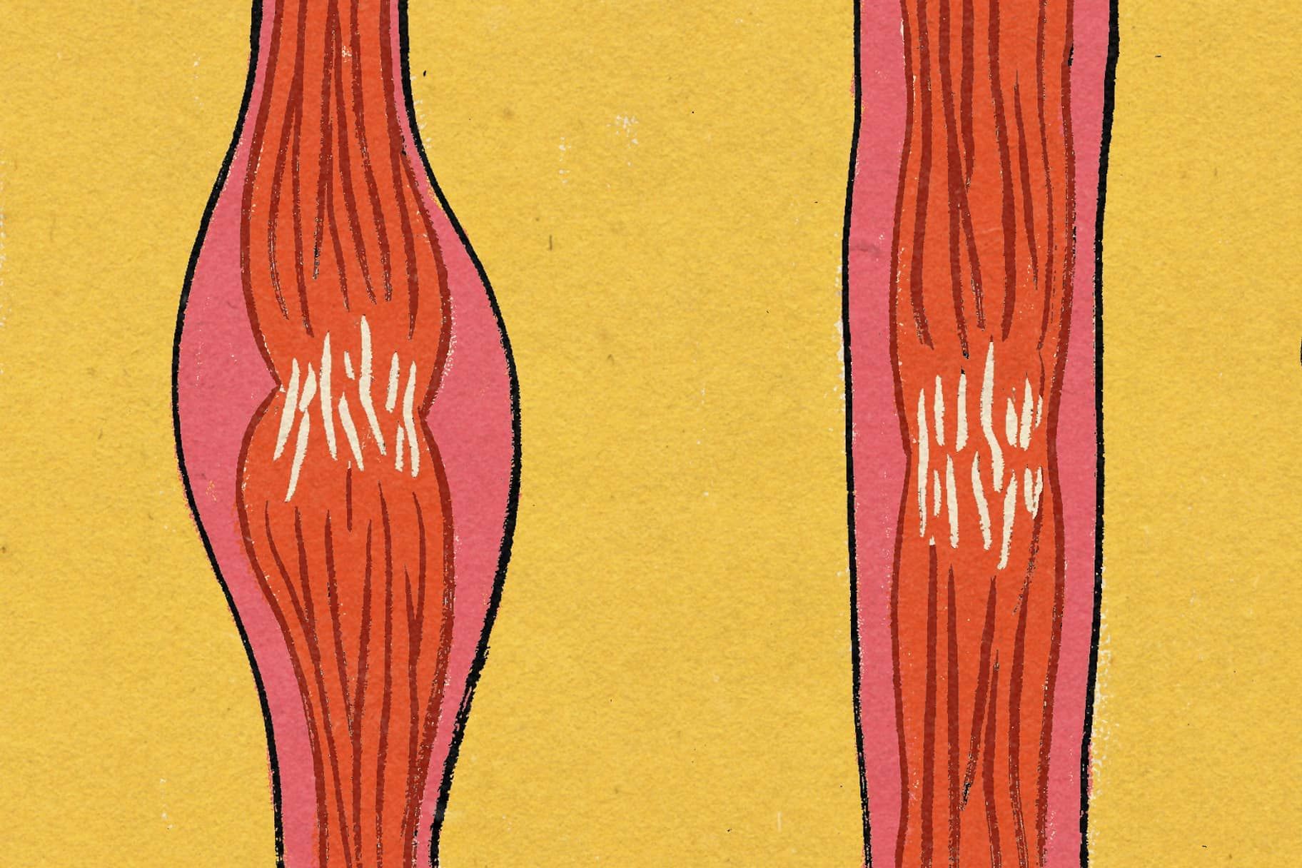 Tendonitis vs. Tendinosis: How To Prevent and Treat Both